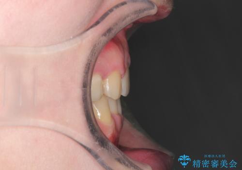 犬歯が変な位置にある　抜歯矯正により正しい位置への治療後