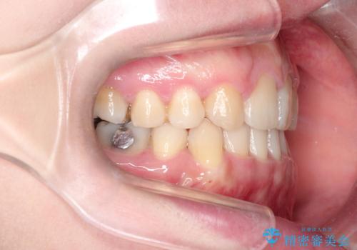 犬歯が変な位置にある 抜歯矯正により正しい位置への治療後