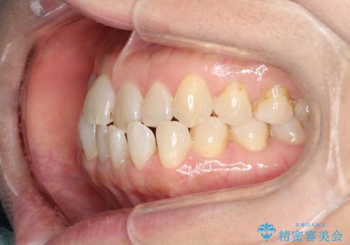 前歯の隙間 インビザラインによる目立たない成人矯正の治療前