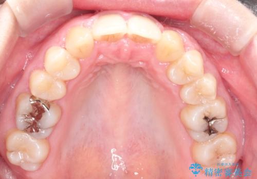 犬歯が変な位置にある 抜歯矯正により正しい位置への治療後