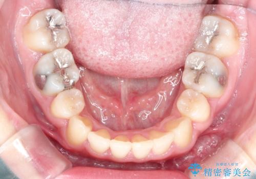 犬歯が変な位置にある 抜歯矯正により正しい位置への治療後