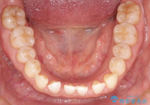 前歯の隙間 インビザラインによる目立たない成人矯正の治療前