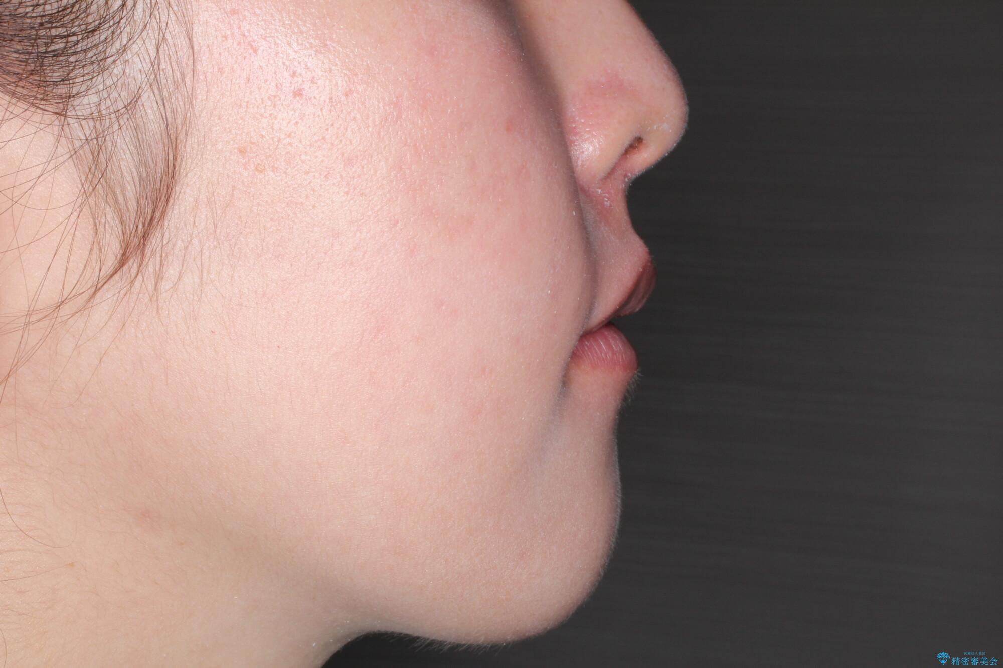 犬歯が変な位置にある 抜歯矯正により正しい位置への治療後(顔貌)