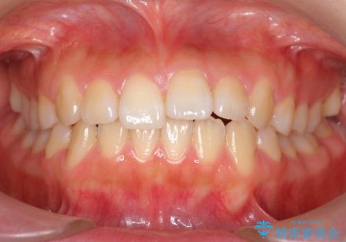 出っ歯　インビザラインで歯を抜かない治療の症例 治療前