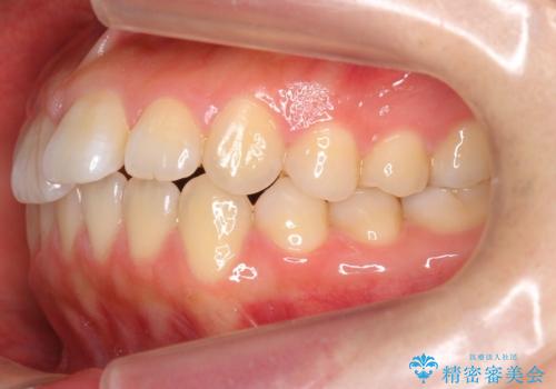 出っ歯　インビザラインで歯を抜かない治療の治療前