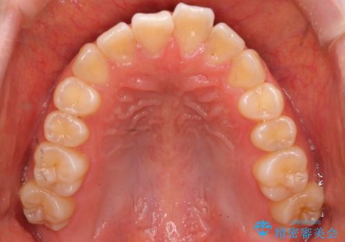 出っ歯 インビザラインで歯を抜かない治療の治療前