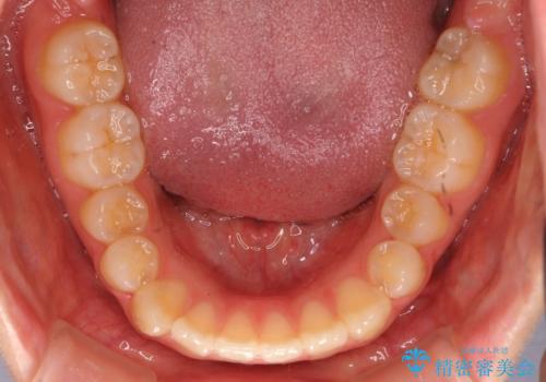 出っ歯 インビザラインで歯を抜かない治療の治療前