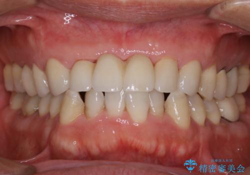 セラミックのチェックと合わせてPMTCの治療前