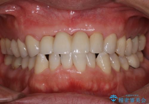 セラミックのチェックと合わせてPMTCの治療後