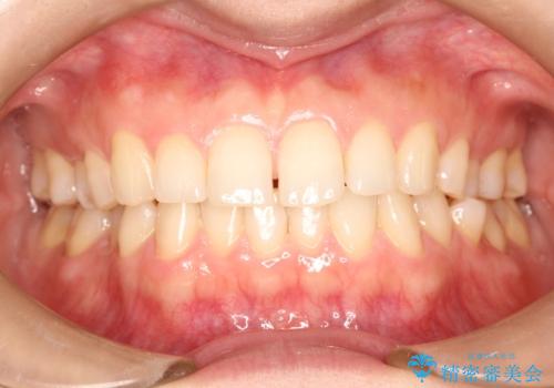 【インビザライン】前歯のガタガタを綺麗にしたい。の症例 治療前