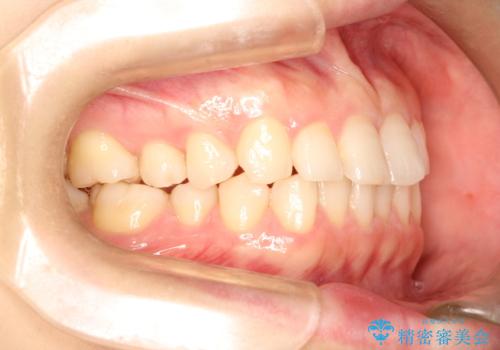 【インビザライン】前歯のガタガタを綺麗にしたい。の治療前
