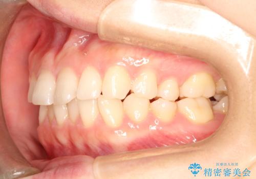 【インビザライン】前歯のガタガタを綺麗にしたい。の治療前