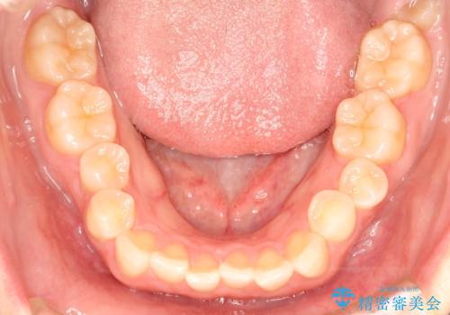 【インビザライン】前歯のガタガタを綺麗にしたい。の治療前