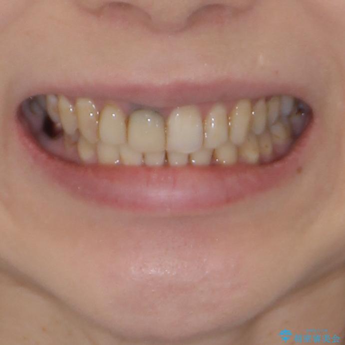 歯並びと目立つ金属を治したい　総合歯科治療の治療後（顔貌）