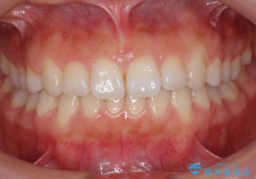 出っ歯　インビザラインで歯を抜かない治療の症例 治療後