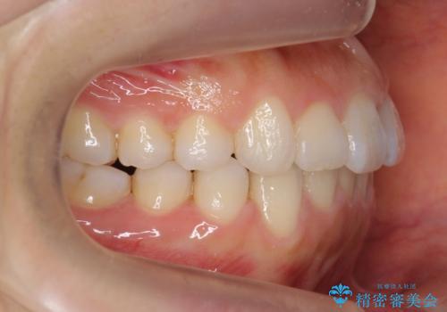 出っ歯 インビザラインで歯を抜かない治療の治療後