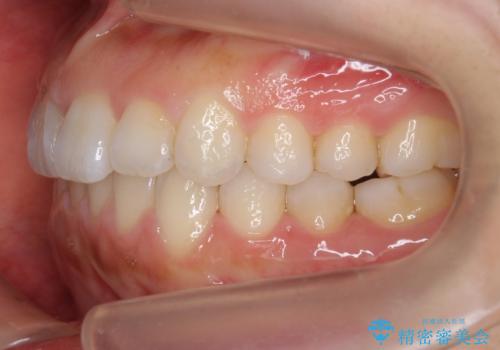 出っ歯　インビザラインで歯を抜かない治療の治療後