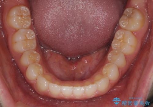 出っ歯　インビザラインで歯を抜かない治療の治療後