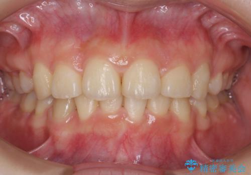 20代女性 出っ歯 口元を引っ込めたいの症例 治療後