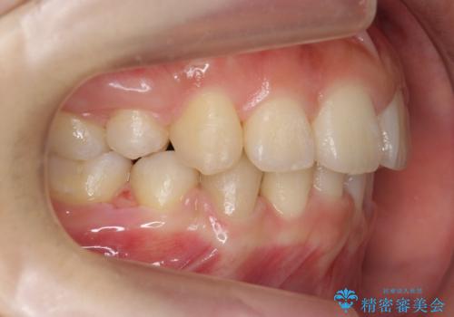 20代女性 出っ歯 口元を引っ込めたいの治療後