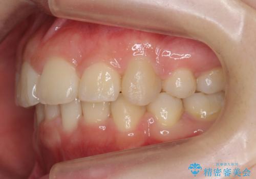 20代女性 出っ歯 口元を引っ込めたいの治療後