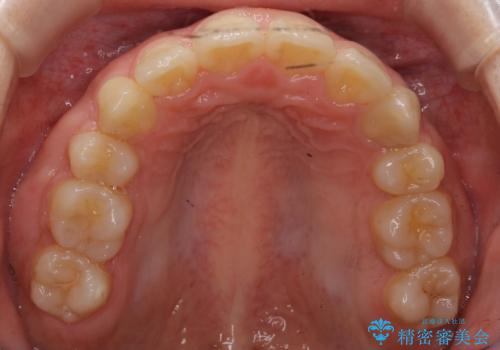 20代女性 出っ歯 口元を引っ込めたいの治療後