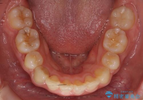 20代女性 出っ歯 口元を引っ込めたいの治療後