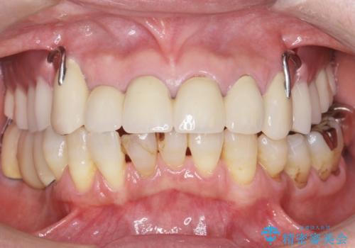 前歯がかけた、ぐらぐらする 60代女性の治療前