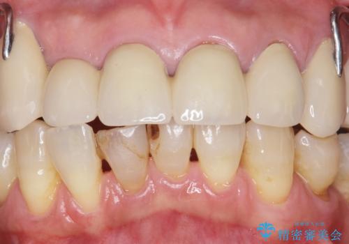 前歯がかけた、ぐらぐらする 60代女性の治療前