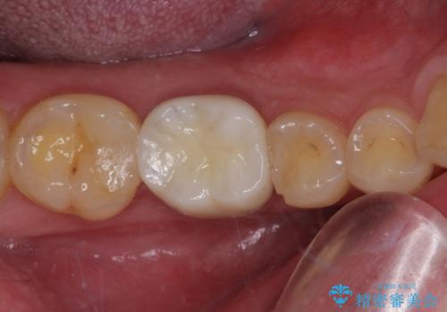 気がついたら歯が欠けていた 奥歯のセラミック補綴の治療後