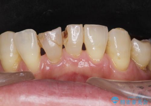 前歯がかけた、ぐらぐらする 60代女性