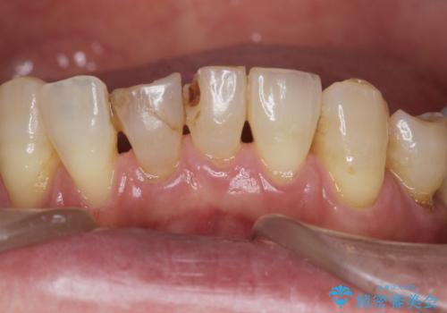 前歯がかけた、ぐらぐらする 60代女性の治療前