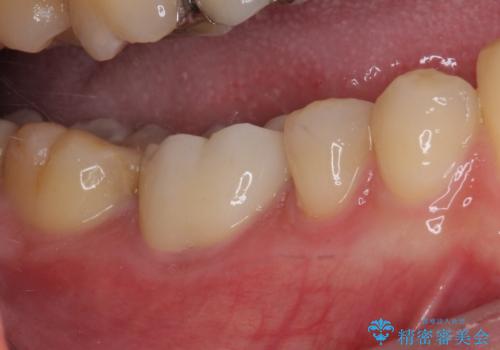 気がついたら歯が欠けていた 奥歯のセラミック補綴の治療後