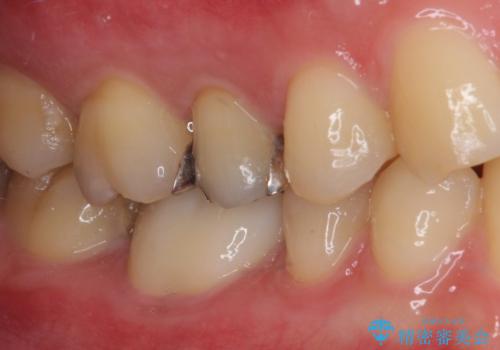 気がついたら歯が欠けていた 奥歯のセラミック補綴の治療後