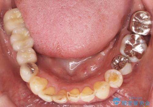 前歯がかけた、ぐらぐらする 60代女性の治療前