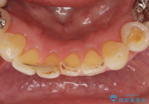 前歯がかけた、ぐらぐらする 60代女性の治療前