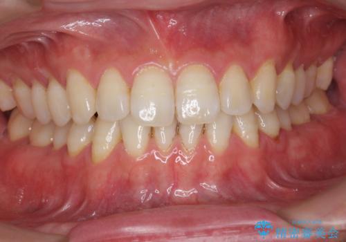 ホワイトニングで口元を明るく爽やかに!!の症例 治療前