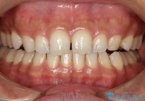 歯と歯の間の着色をPMTCでできる限り除去の治療前
