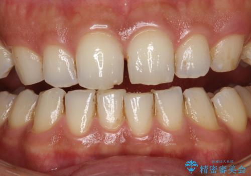 歯と歯の間の着色をPMTCでできる限り除去の症例 治療前