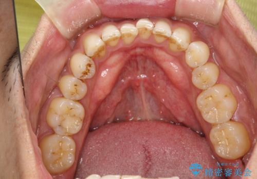 歯と歯の間の着色をPMTCでできる限り除去の治療前