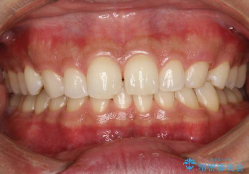 歯と歯の間の着色をPMTCでできる限り除去の治療後