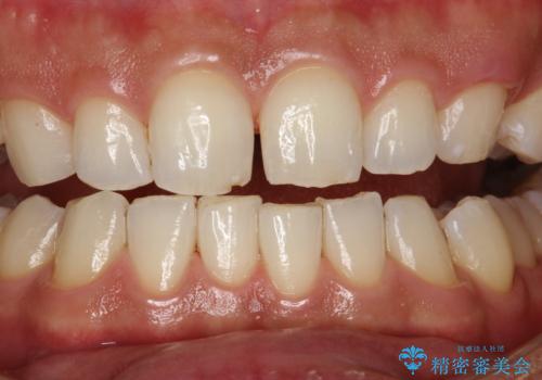 歯と歯の間の着色をPMTCでできる限り除去の治療後
