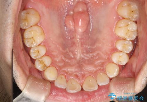 歯と歯の間の着色をPMTCでできる限り除去の治療後