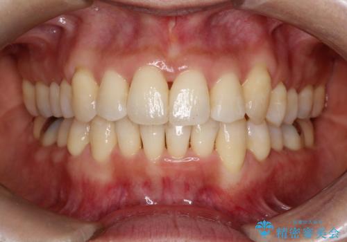 重度のガタガタのインビザラインによる非抜歯矯正の症例 治療後