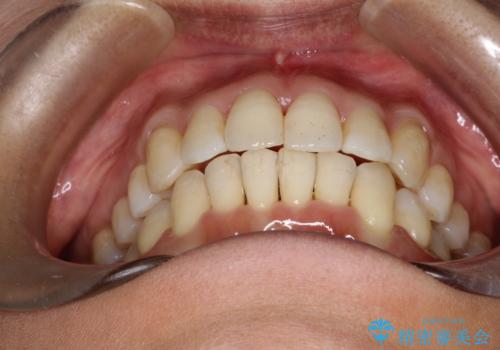 重度のガタガタのインビザラインによる非抜歯矯正の治療後