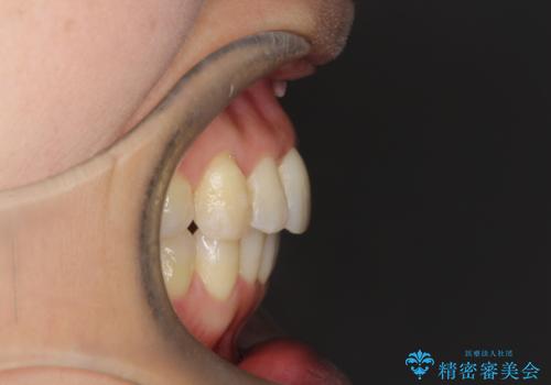 重度のガタガタのインビザラインによる非抜歯矯正の治療後