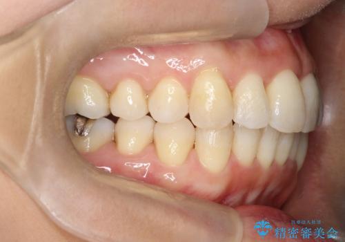 重度のガタガタのインビザラインによる非抜歯矯正の治療後