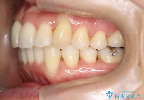 重度のガタガタのインビザラインによる非抜歯矯正の治療後