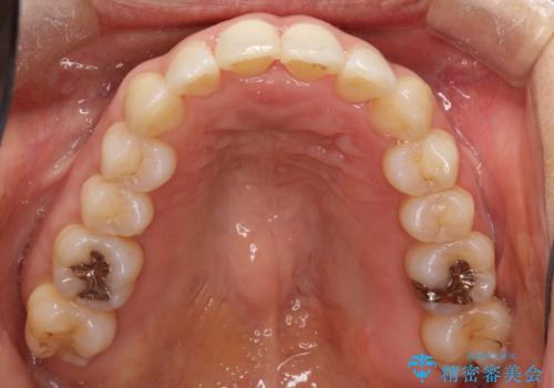 重度のガタガタのインビザラインによる非抜歯矯正の治療後