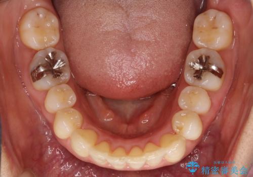 重度のガタガタのインビザラインによる非抜歯矯正の治療後